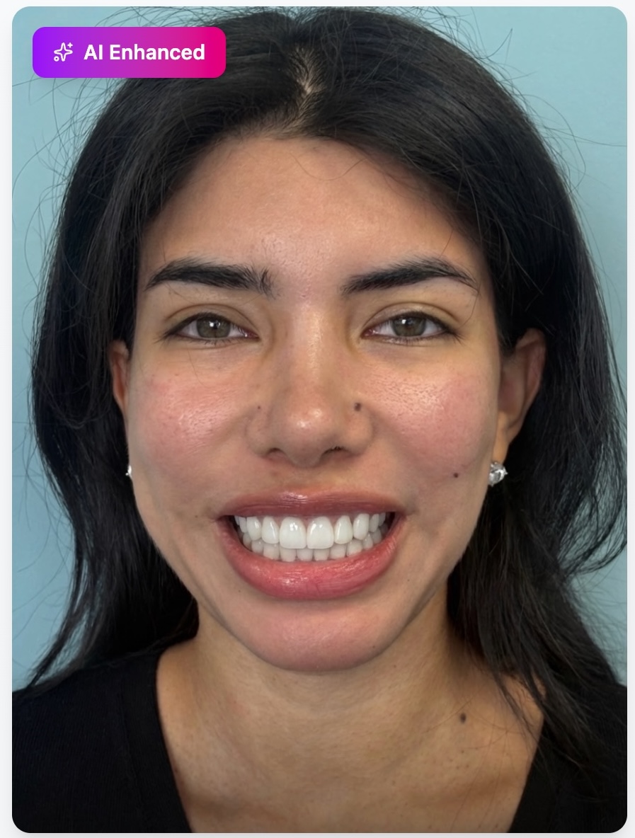 After AI smile enhancement